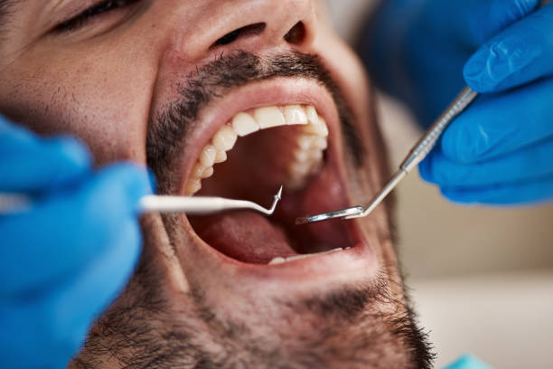 Best Wisdom Tooth Removal  in White Oak, TX